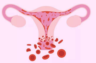 妇炎丸可以治疗子宫内膜增生导致的月经不调吗