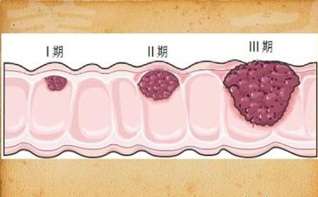 口味太重或致肠癌 应“管好”出入口