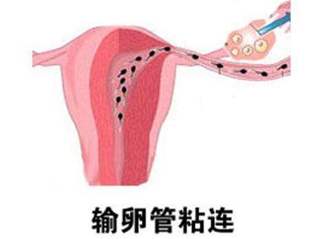 输卵管粘连总是反复发作 原因竟然是这些