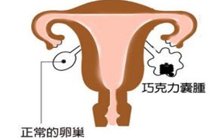 探秘卵巢囊肿和附件囊肿关系 妇炎丸可消除囊肿