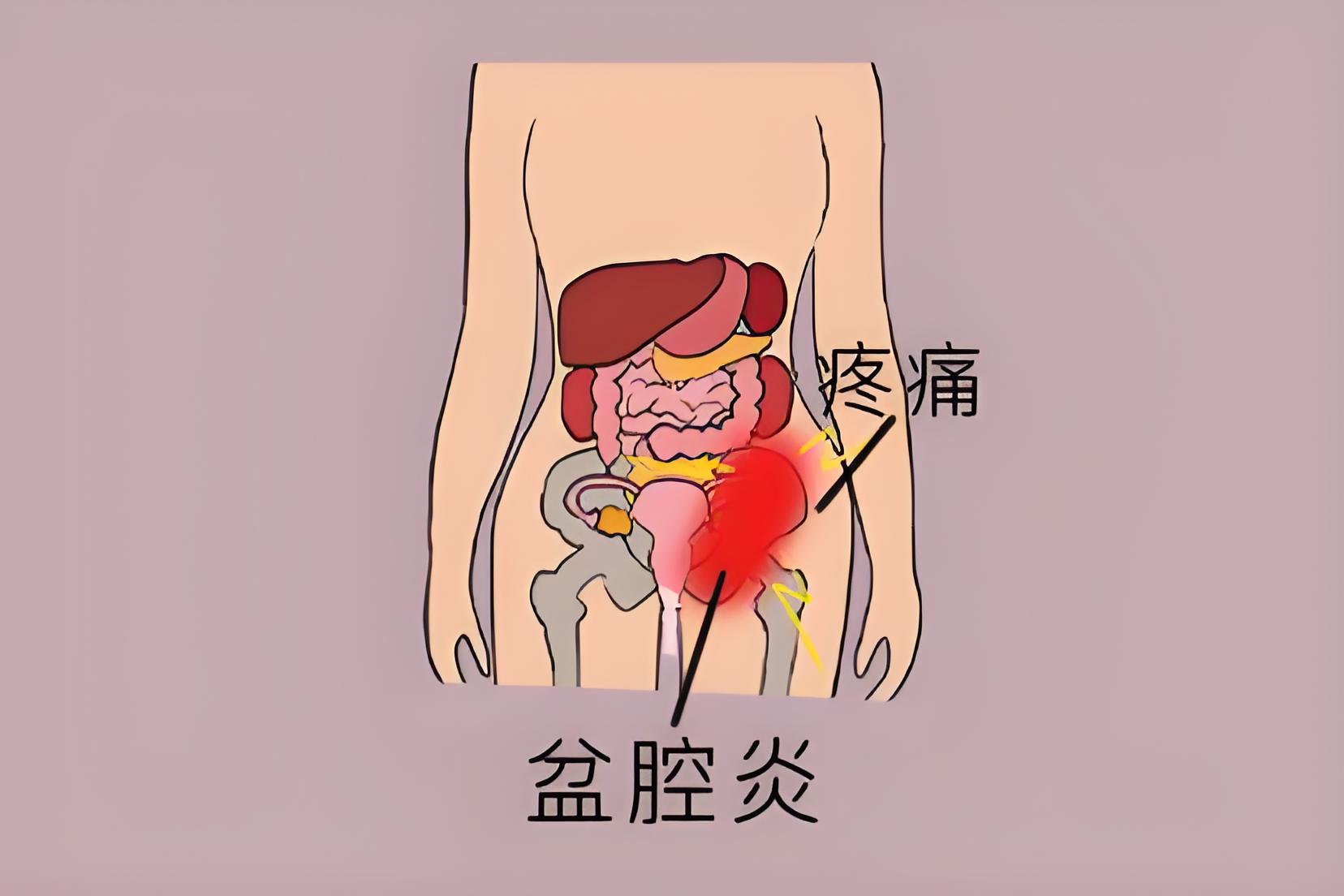 盆腔炎用什么药物治疗比较好？盘点治疗药物（必遵医嘱）