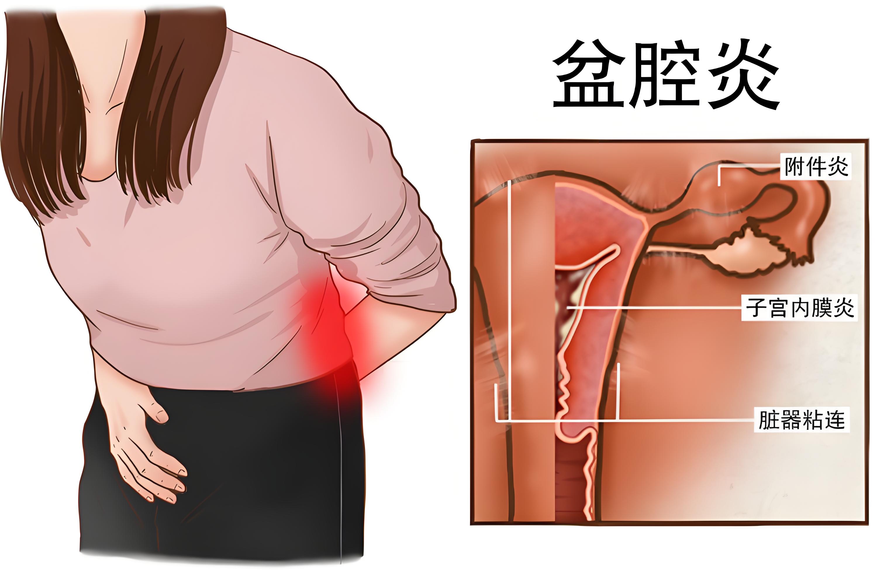 盆腔炎疼痛位置：下腹三角区+腰骶部放射痛！可对照位置自查
