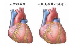 全身乏力，气喘胸闷  或是病毒性心肌炎