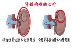 腹围渐涨伴剧烈腹痛 检查是肾脏错构瘤