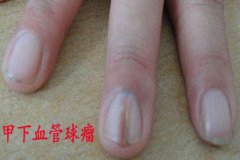 指甲疼十多年原是甲下血管球瘤