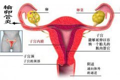 双侧输卵管炎并伞端不全梗阻的危害和治疗