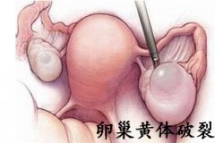 女子卵巢黄体破裂 紧急送医急救