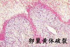 洞房后腹痛到晕倒 竟是卵巢黄体破裂