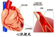 学生体育课上出现胸痛胸闷 原是心肌梗死