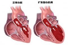 胸闷喘不过气 小姑娘罹患扩张性心肌病