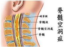 脊髓空洞症 让她瘫软在炕上站不起来