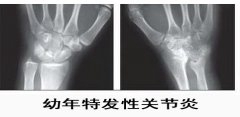 幼年特发性关节炎 让她服药后变“毛孩”