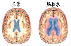 结核性脑膜炎让她脑积水昏迷 但男友不离不弃