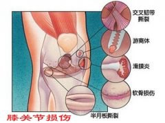减肥选择跳神 锻炼过猛导致膝关节损伤