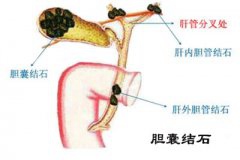 海吃引爆“结石炸弹” 腹痛元凶是胆囊结石