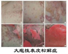 女孩患病成蝴蝶宝贝 病源是大疱性表皮松解症