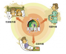 文眉后感染丙肝 盘点丙肝感染途径