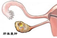 减肥不当累及输卵管 原是输卵管卵巢冠囊肿惹祸