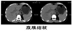 腹痛入院下病危通知书 腹膜结核误诊为卵巢癌