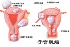 生育后莫名痛经5年 经诊断患子宫肌瘤