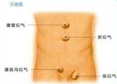 莫名发福肚子隆起大山包 原是腹壁疝
