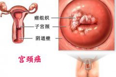 宫颈癌来袭 注射疫苗并非是一劳永逸的事