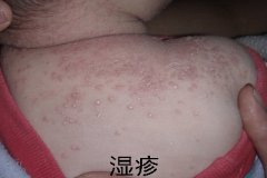 春季湿疹反复 爱孩子更应学些护理小常识