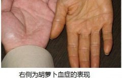 橘黄症就是胡萝卜素血症