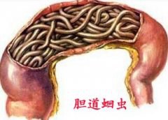 经常不明原因腹痛 竟是胆道蛔虫惹祸