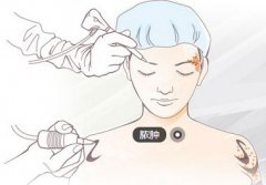 老人被老鼠咬伤 全身奇痒却不是“鼠咬热”