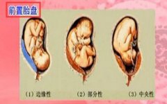 胎盘前置需警惕 防护措施不可少