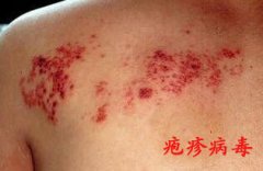 当疱疹病毒来袭  早期预防很重要