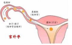 印女子宫外孕36年胎儿只剩骸骨  宫外孕不可忽视