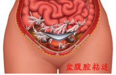 阴道不规则出血 术中发现盆腹腔粘连封闭