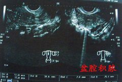 下腹部剧烈疼痛伴随高热 一度被诊断盆腔积脓