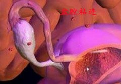 盆腔粘连易致女性不孕 干预治疗解忧愁