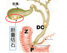 持续右上腹疼痛 警惕胆囊结石可能