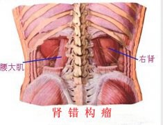 女童肚子莫名长大如怀孕 检查得知是肾错构瘤