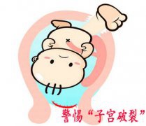 女性产后短期再孕 易致子宫破裂