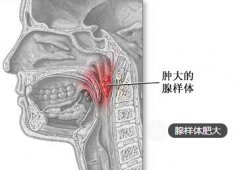 鼻塞咽喉痛  莫把腺样体肥大误当感冒