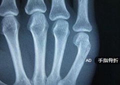 撕名牌游戏导致手负伤  遭遇手指骨折