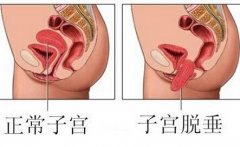 初为人母 警惕产后子宫脱垂