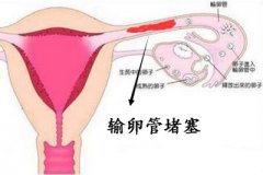 宫外孕后输卵管堵塞 治疗更需谨慎