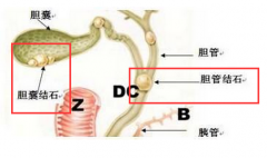 饮食搭配不合理 唯恐患上胆结石