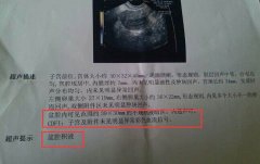 病理性盆腔积液 查明原因针对治疗