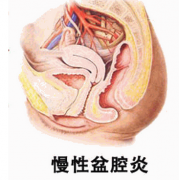 慢性盆腔炎的治疗 预后有三