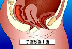 阴道常有东西掉出体外 警惕子宫脱垂