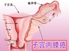 月经滴滴答答的老不干净 查出子宫内膜癌