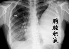 硬壳食物割破食管  食物掉进胸腔致胸腔积液