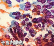 绝经多年月经返潮 检查是子宫内膜癌